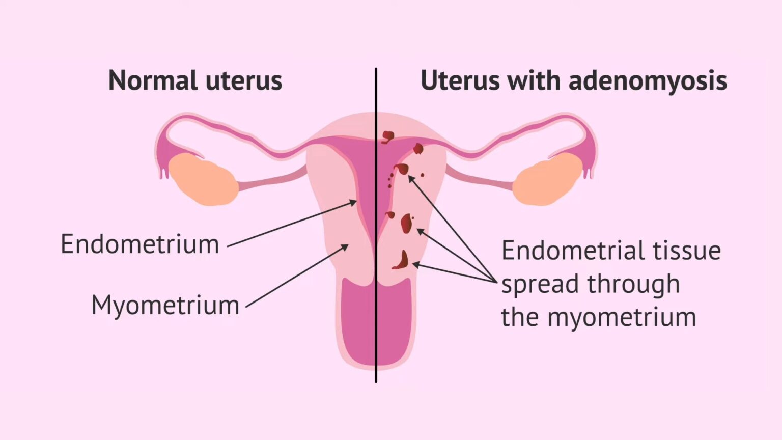 Top 6 Causes Of Blood Clots During Periods to Know About